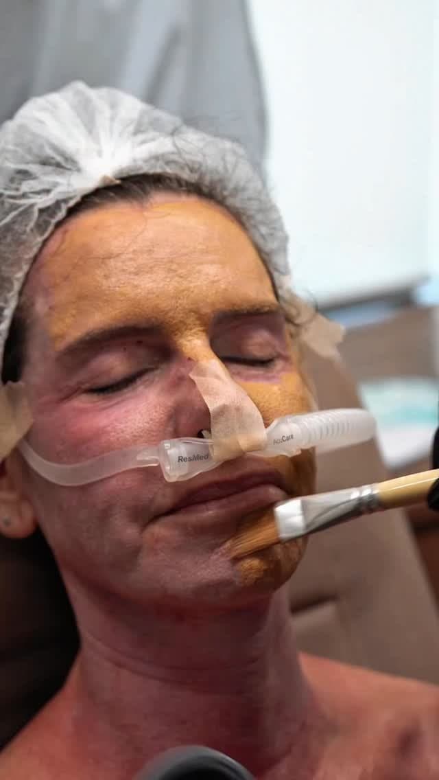 Aplicação de peeling no rosto, em close