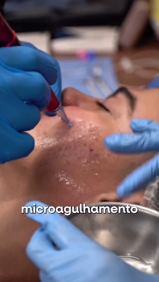 Aplicação de microagulhamento durante a prática hands-on