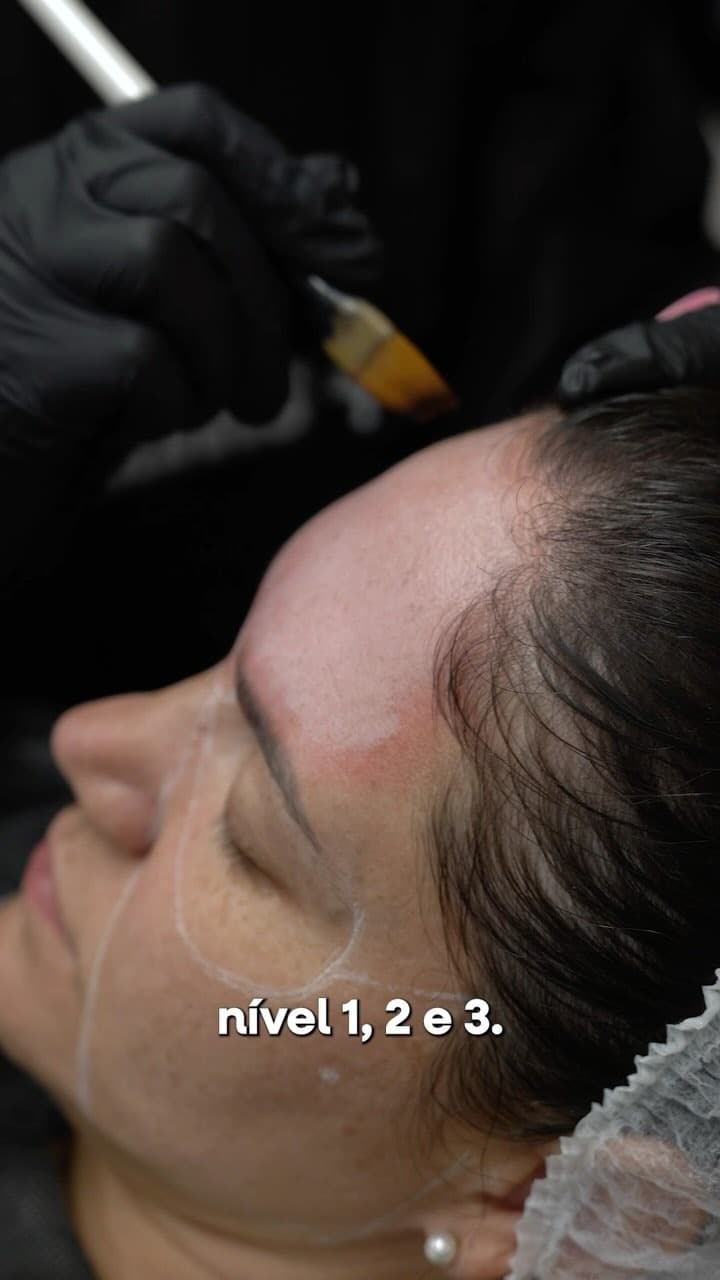 Aplicação de peeling com demarcação das áreas de tratamento