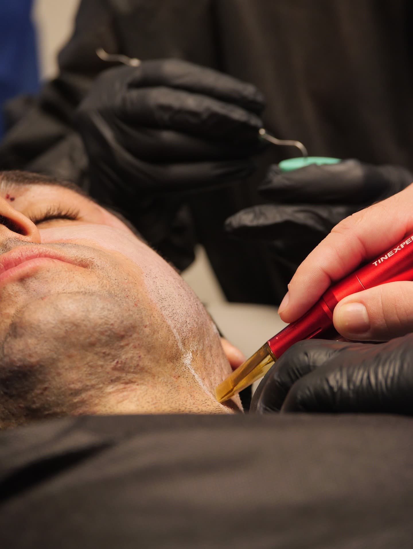 Aplicação de peeling na linha da mandíbula, em close