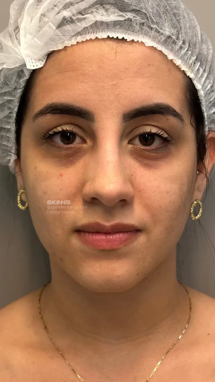 Blefaroplastia Química — Antes