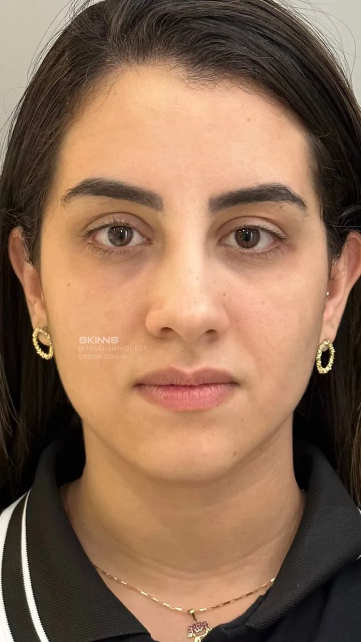Blefaroplastia Química — Depois