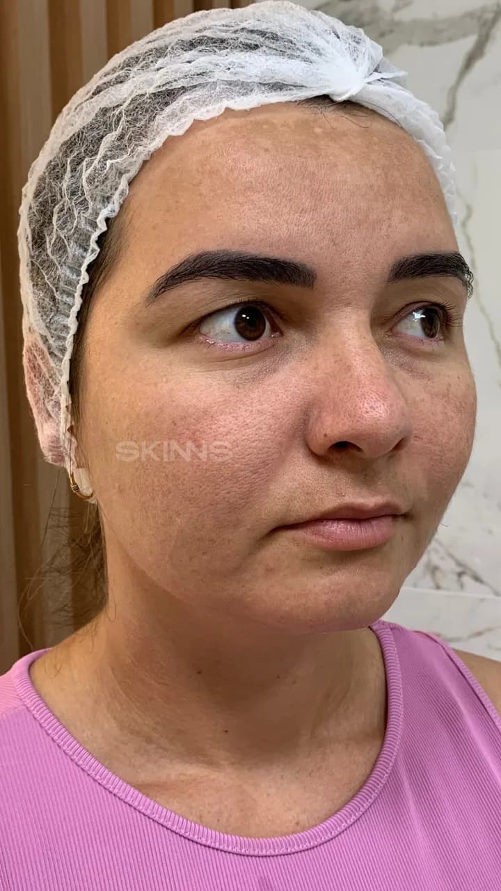 SKIMS Melani — Antes