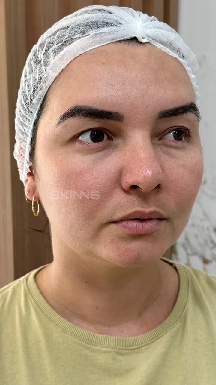 SKIMS Melani — Depois