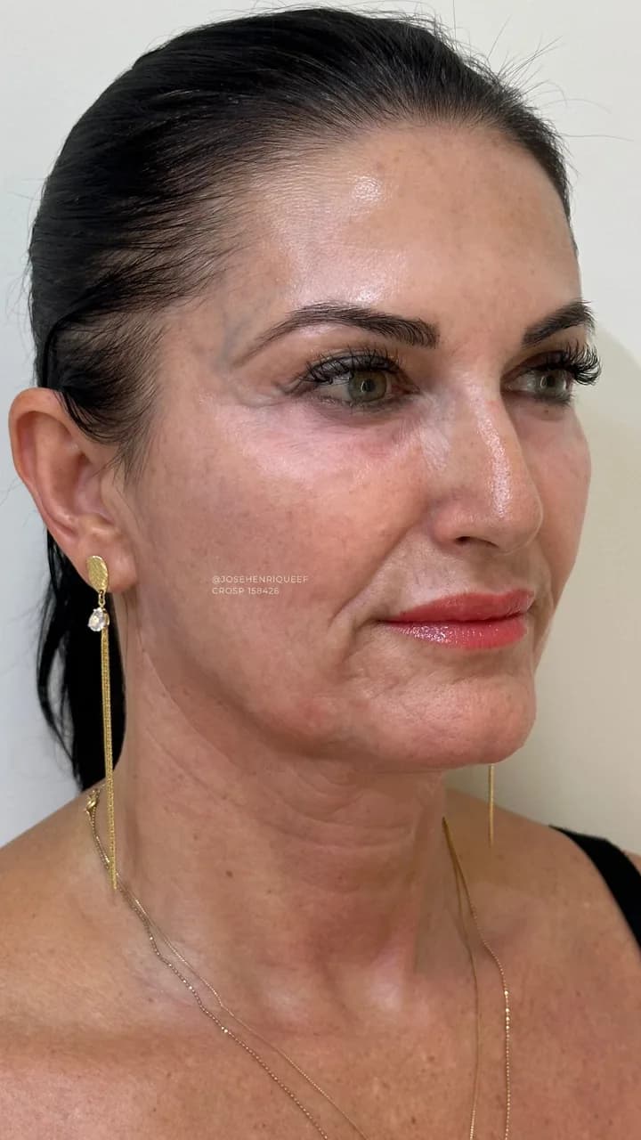 SKIMS Rejuvenescimento — Depois