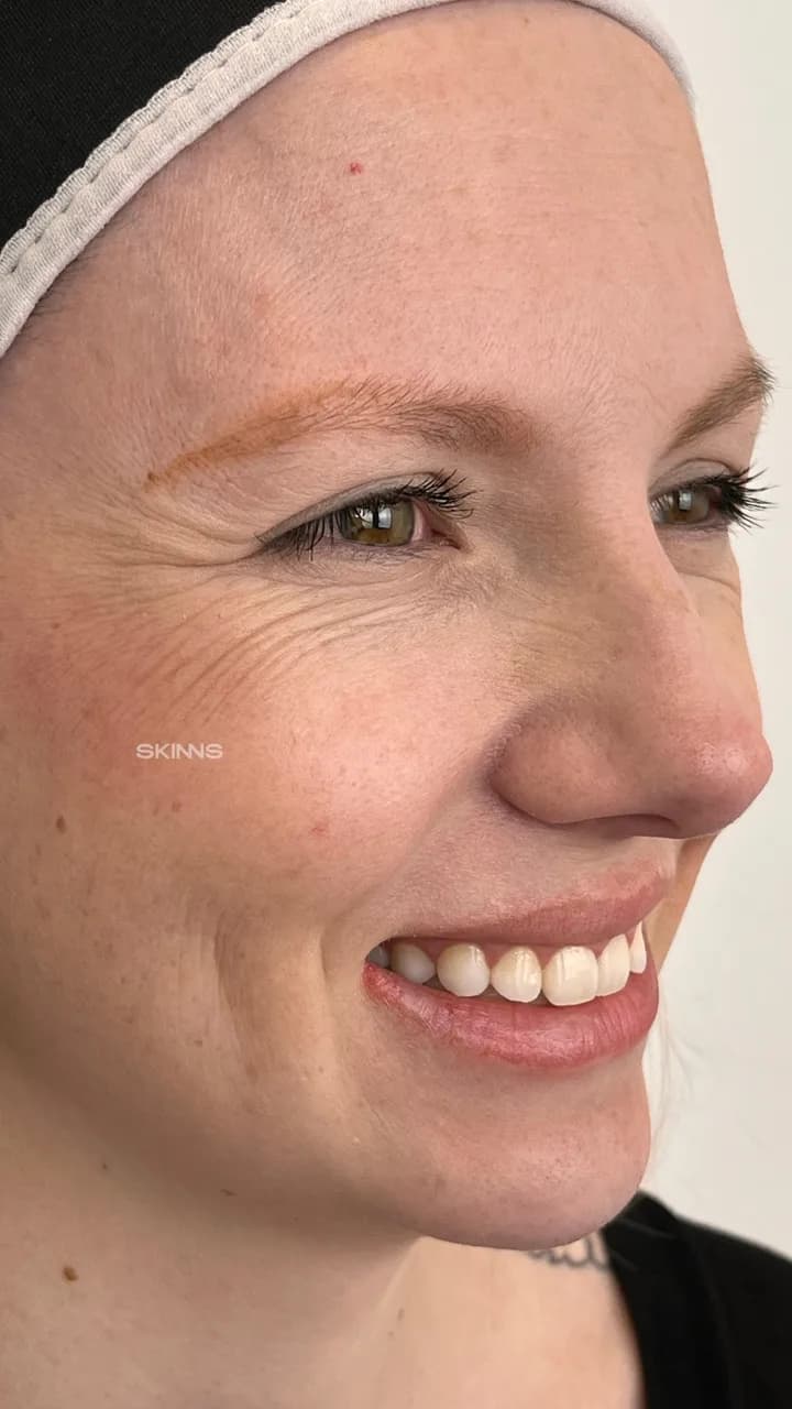 Blefaroplastia Química — Gabriela — Antes