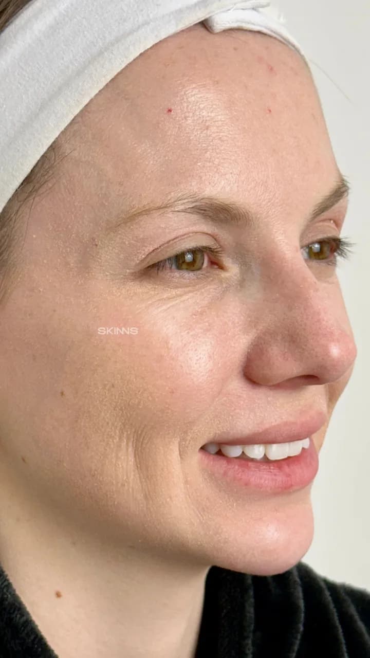 Blefaroplastia Química — Gabriela — Depois
