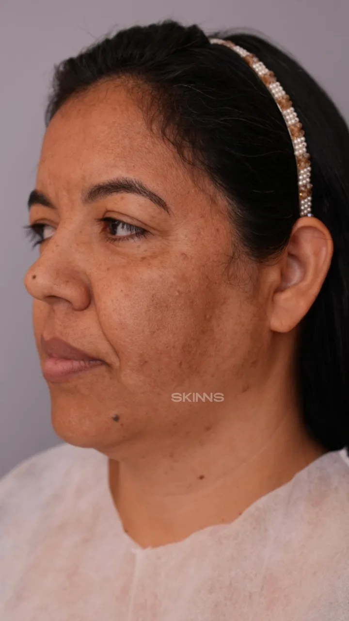 SKIMS Melani — Elica — Antes