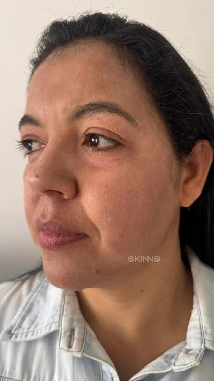 SKIMS Melani — Elica — Depois