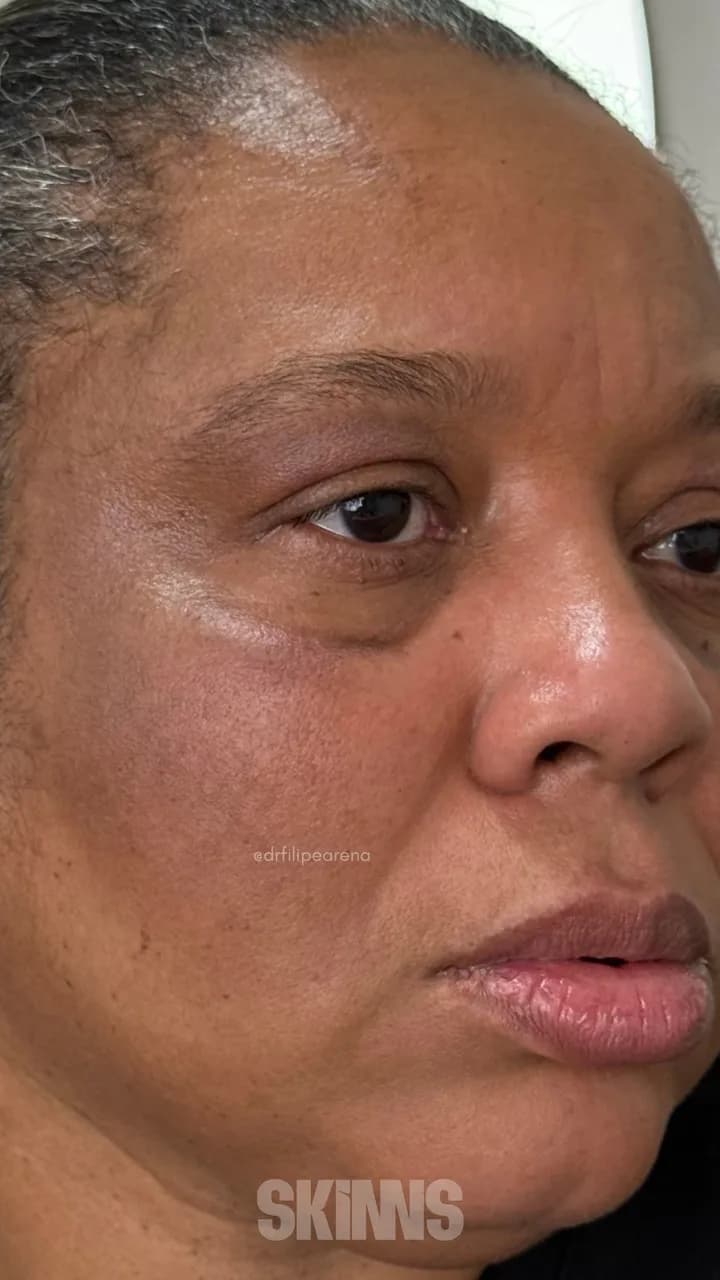 SKIMS Melani — Marcia — Depois