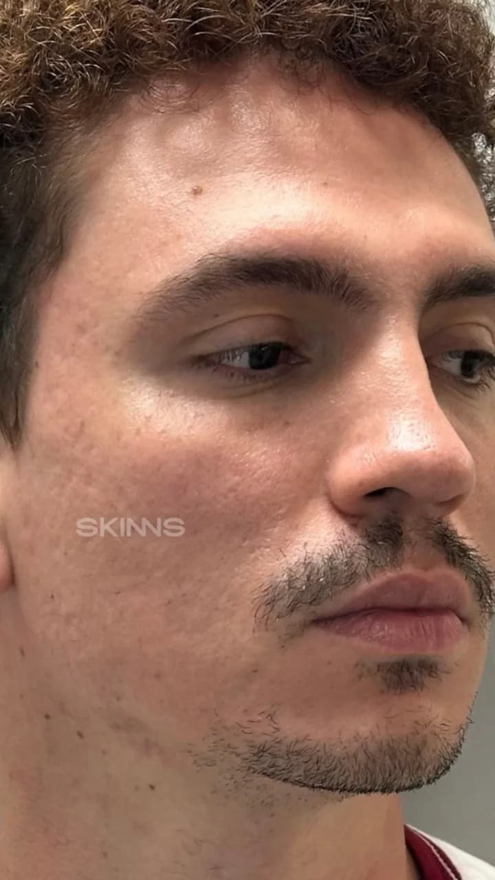 SKIMS Point — Everton — Depois