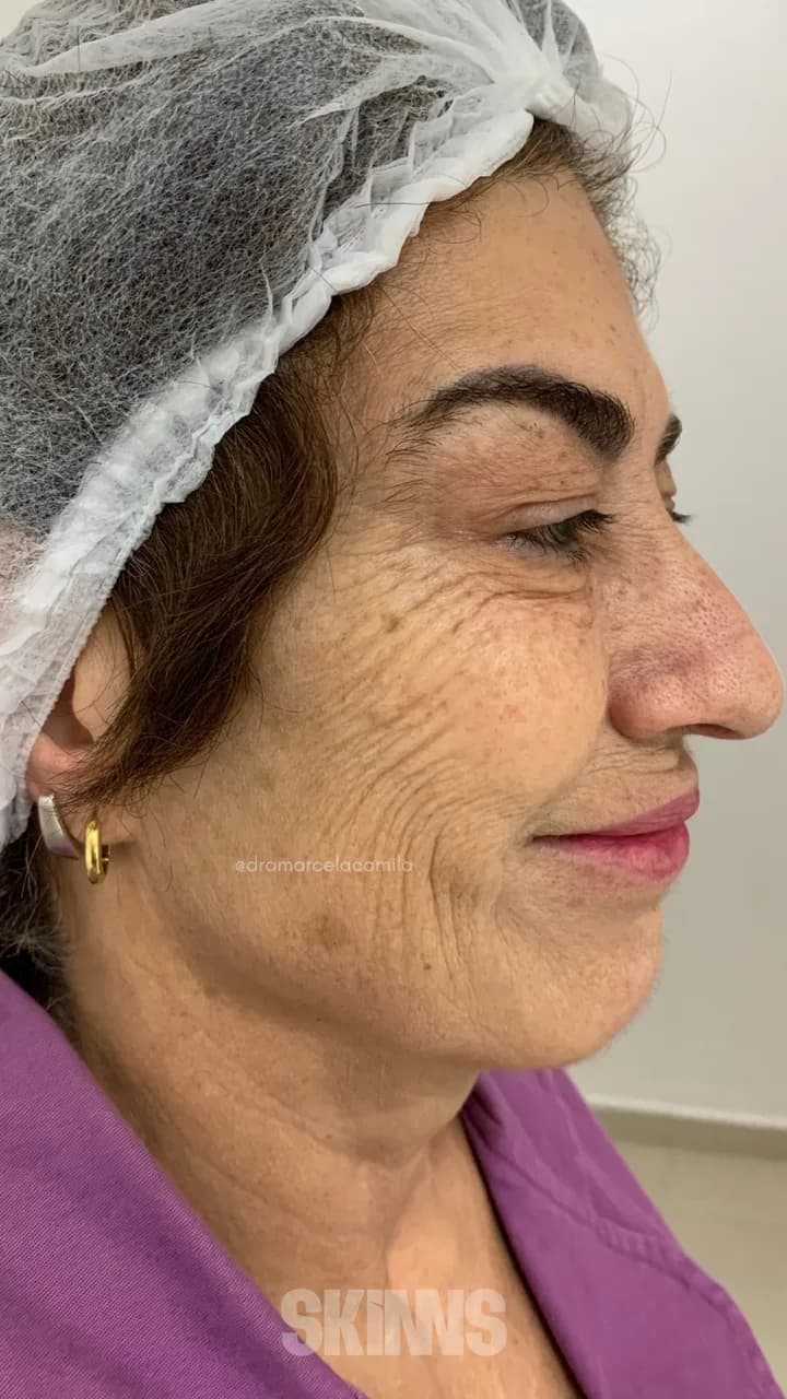SKIMS Rejuvenescimento — Helena — Antes