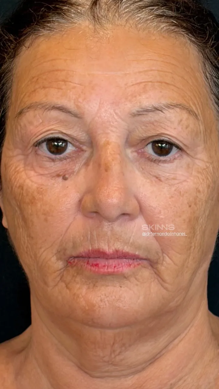 SKIMS Rejuvenescimento — Maria — Antes
