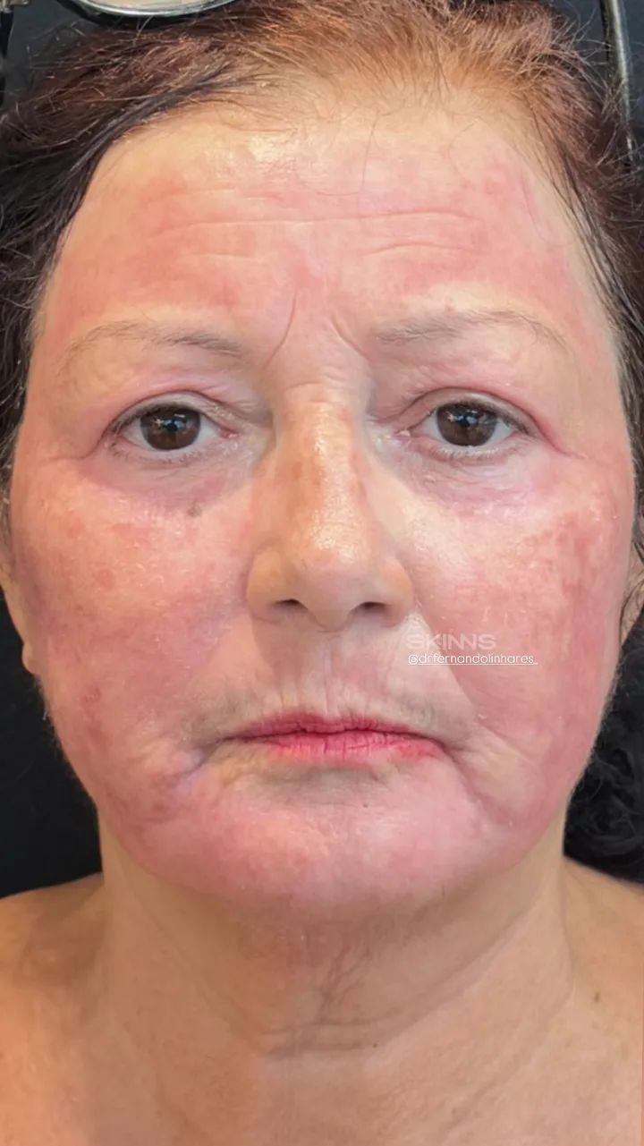 SKIMS Rejuvenescimento — Maria — Depois