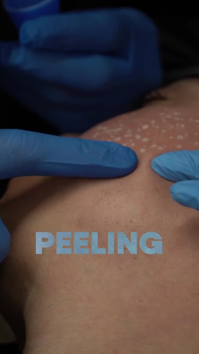 Peel application on the back during the Immersion
