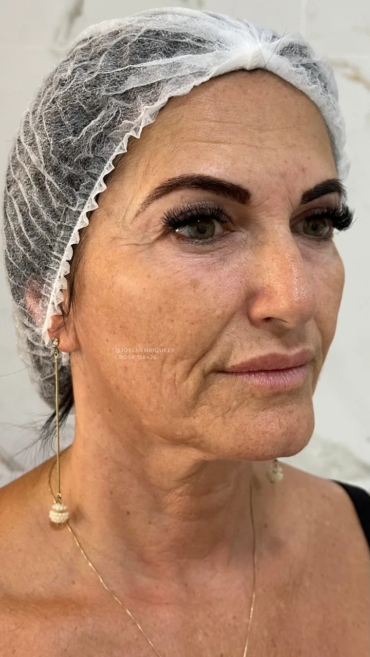 SKIMS Rejuvenescimento — Antes