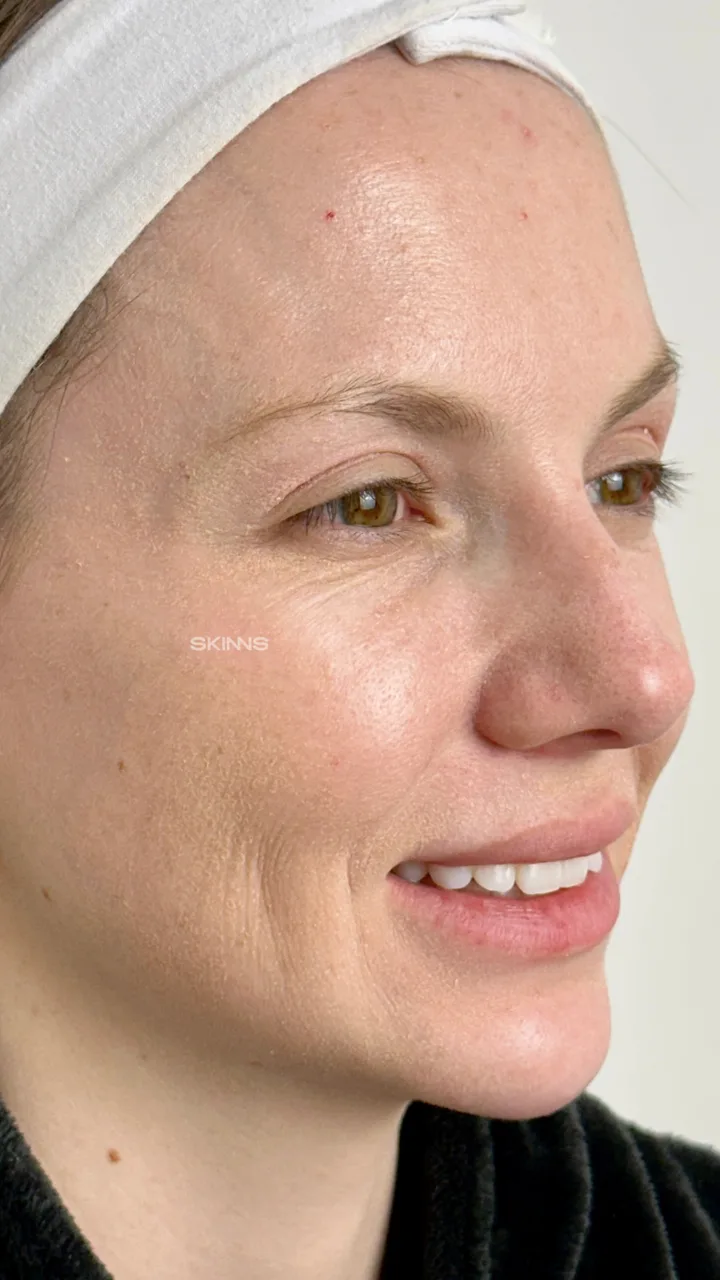 Blefaroplastia Química — Gabriela — Después