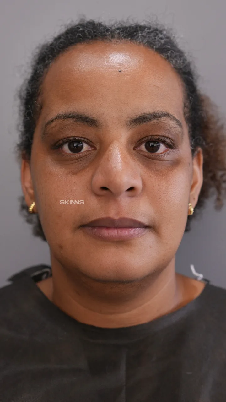 Blefaroplastia Química — Rosana — Antes