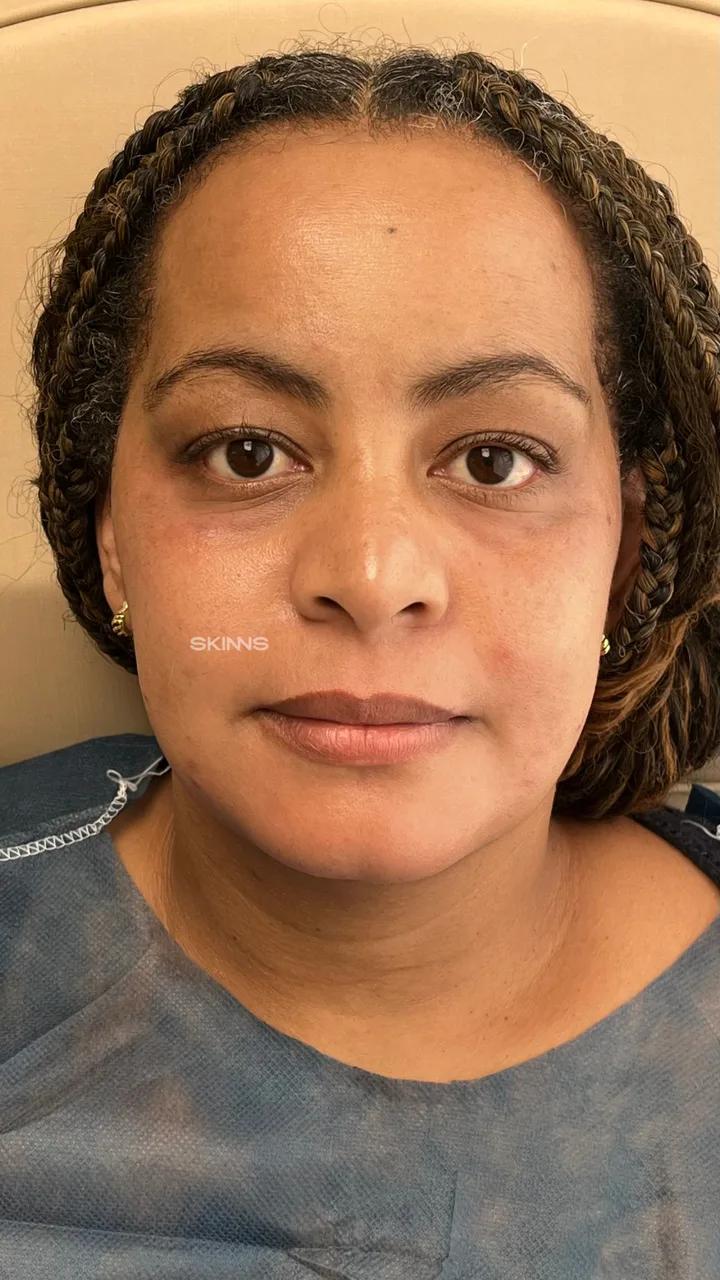 Blefaroplastia Química — Rosana — Después
