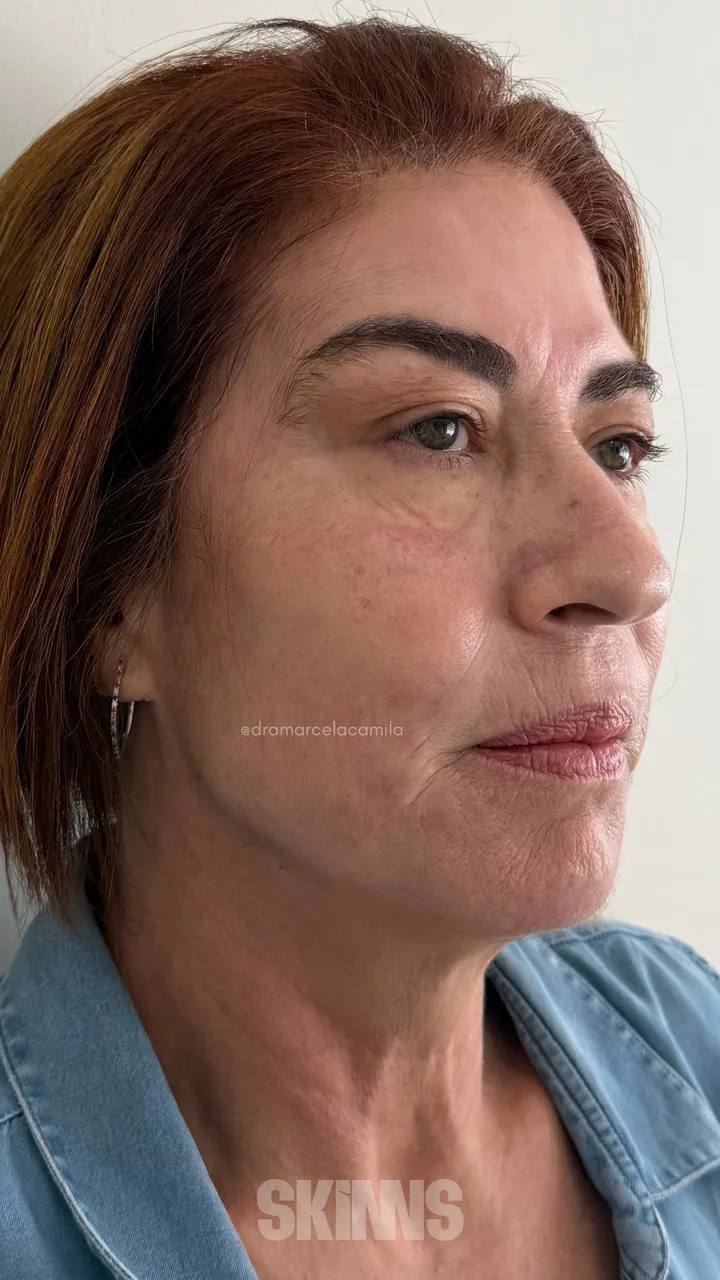 SKIMS Rejuvenescimento — Helena — Después